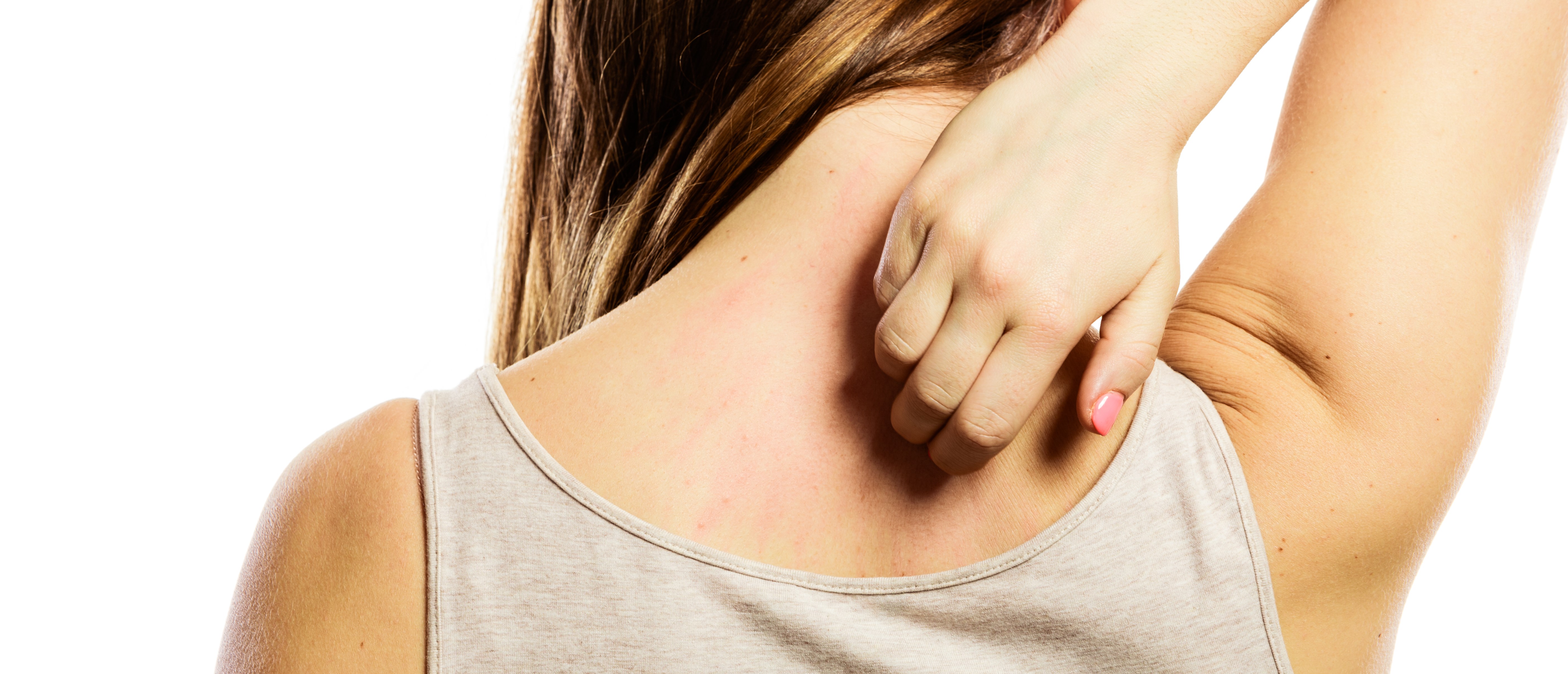 How to deal with heat rash, Skin Guides